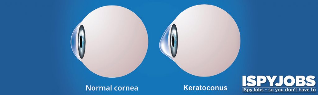 A pair of eyes showing symptoms of Keratoconus. 